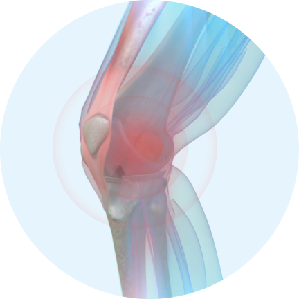 лечение артроза колена фото